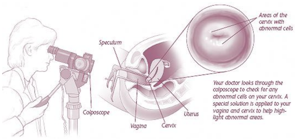 Colposcopy - WomenCare of Baldwin Park